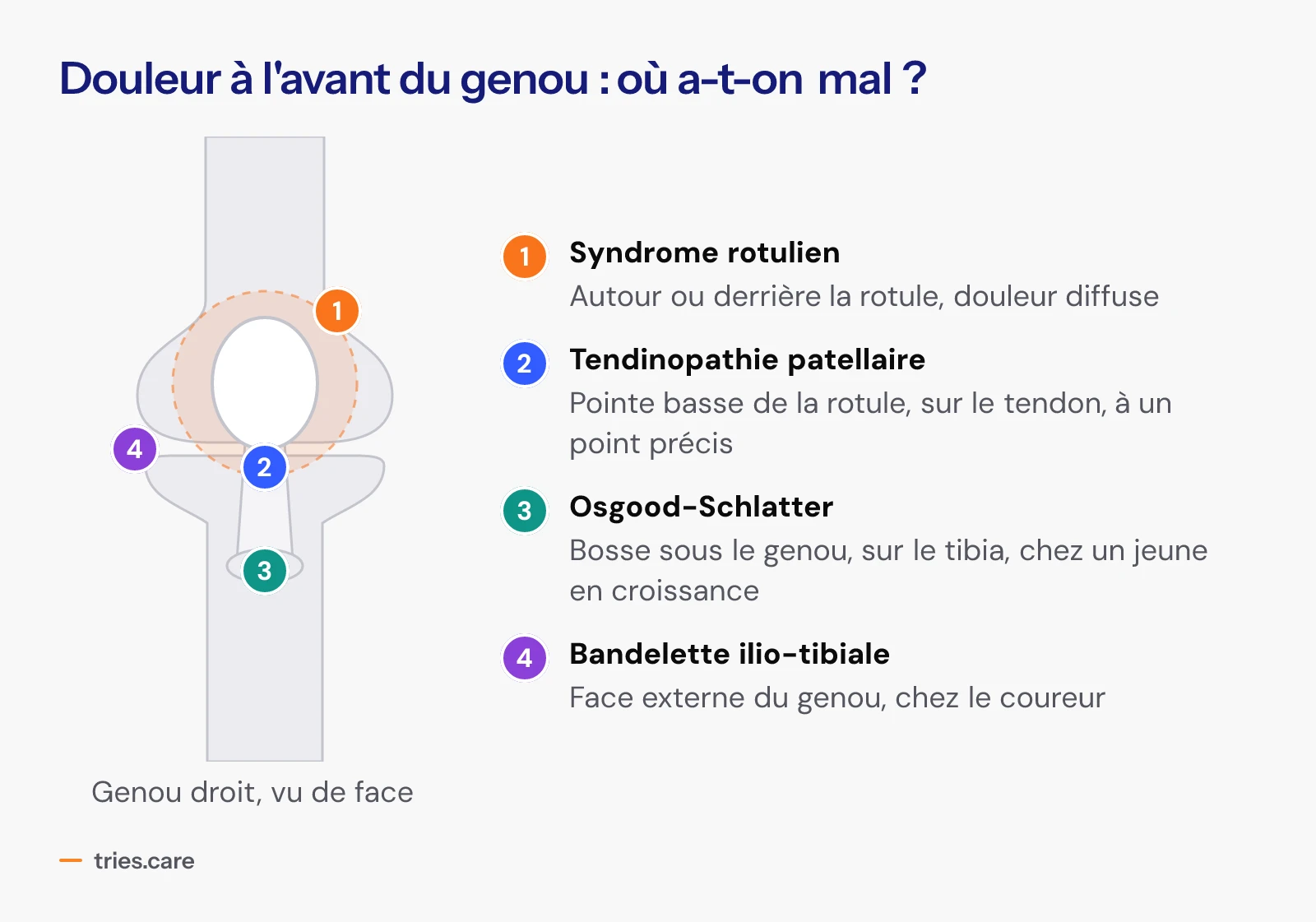 Schéma d'un genou droit vu de face avec quatre zones numérotées. 1, syndrome rotulien : autour ou derrière la rotule, douleur diffuse. 2, tendinopathie patellaire : pointe basse de la rotule, sur le tendon, à un point précis. 3, maladie d'Osgood-Schlatter : bosse sous le genou, sur le tibia, chez un jeune en croissance. 4, syndrome de la bandelette ilio-tibiale : face externe du genou, chez le coureur.